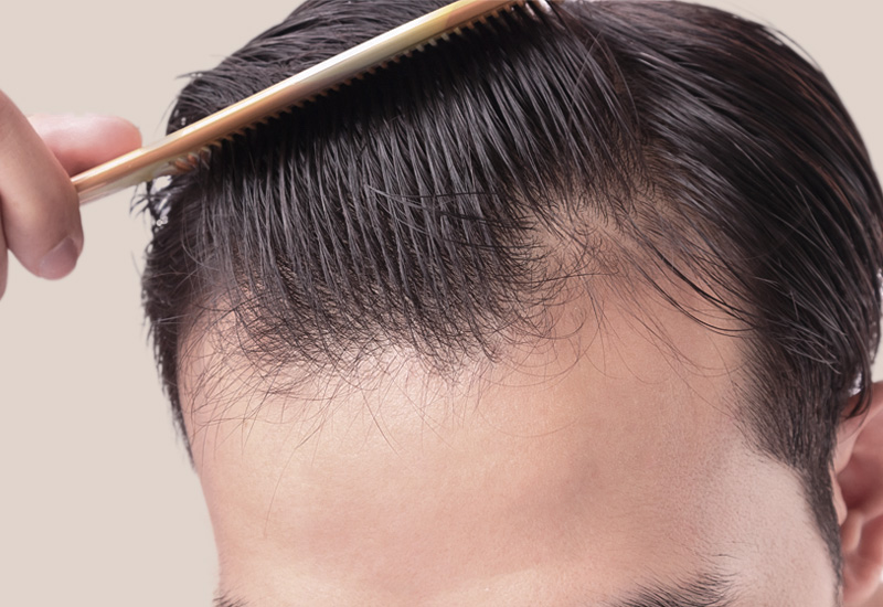 Haartransplantation geheimratsecken für kosten ▷ Tonsur: