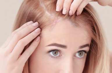 Hair transplants in scars