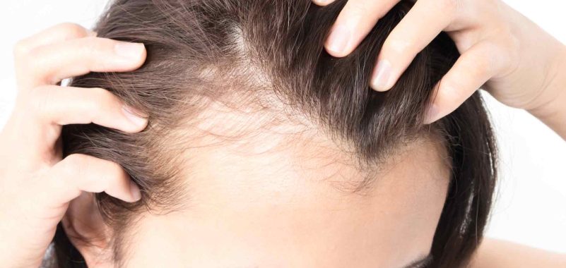 Haarausfall – vernarbende Alopezie